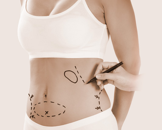 TUMMY TUCK