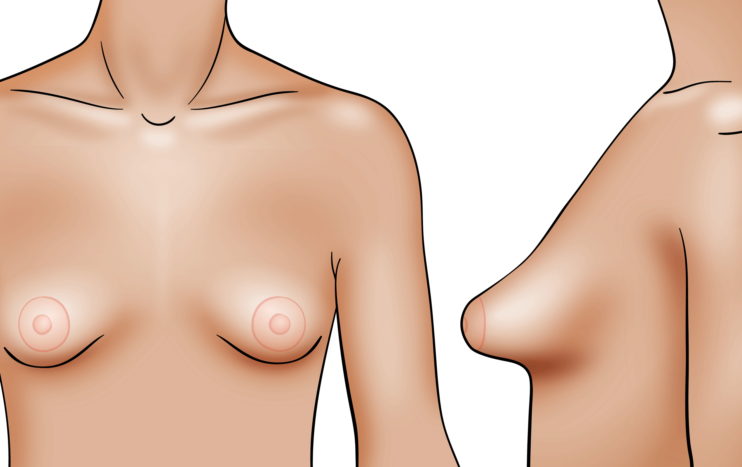 Tubular Breasts  Houston Plastic and Reconstructive Surgery